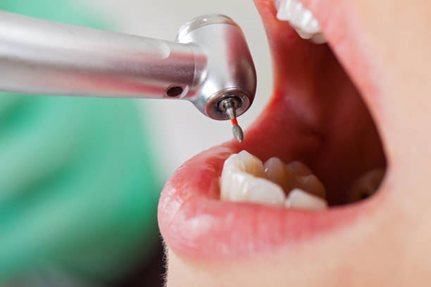 Best Emergency Tooth Extraction in Weston, FL